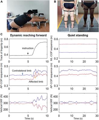 Abnormal balance control mechanisms during dynamic reaching forward and quiet standing in patients with anterior cruciate ligament reconstruction